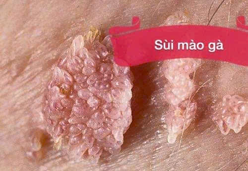 Trị Sùi Mào Gà Bằng Thuốc Nam